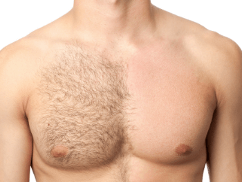 Male chest with half laser hair removal