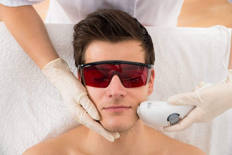 Facial laser hair removal